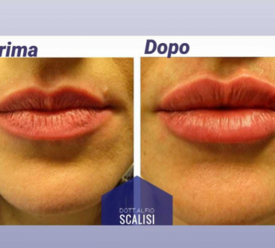 Filler labbra  Dr Alfio Scalisi